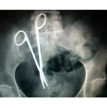 کوئٹہ میں ڈاکٹر دوران آپریشن قینچی مریض کے پیٹ میں بھول گیا